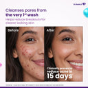 Venusia Acne Facewash With Sebum Control & Hydrating Formula (75gm)