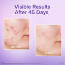 Venusia Dr. Reddy's Acne Moisturizing Gel (60gm)