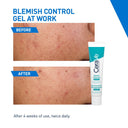  AHA & Niacinamide for Acne Spot Treatment (40ml) Online in India