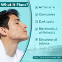 Shop Fixderma Anti Acne Face Serum For Oily Skin & Spot Treatment (15g) Online in India Chennai Tamil Nadu / Review